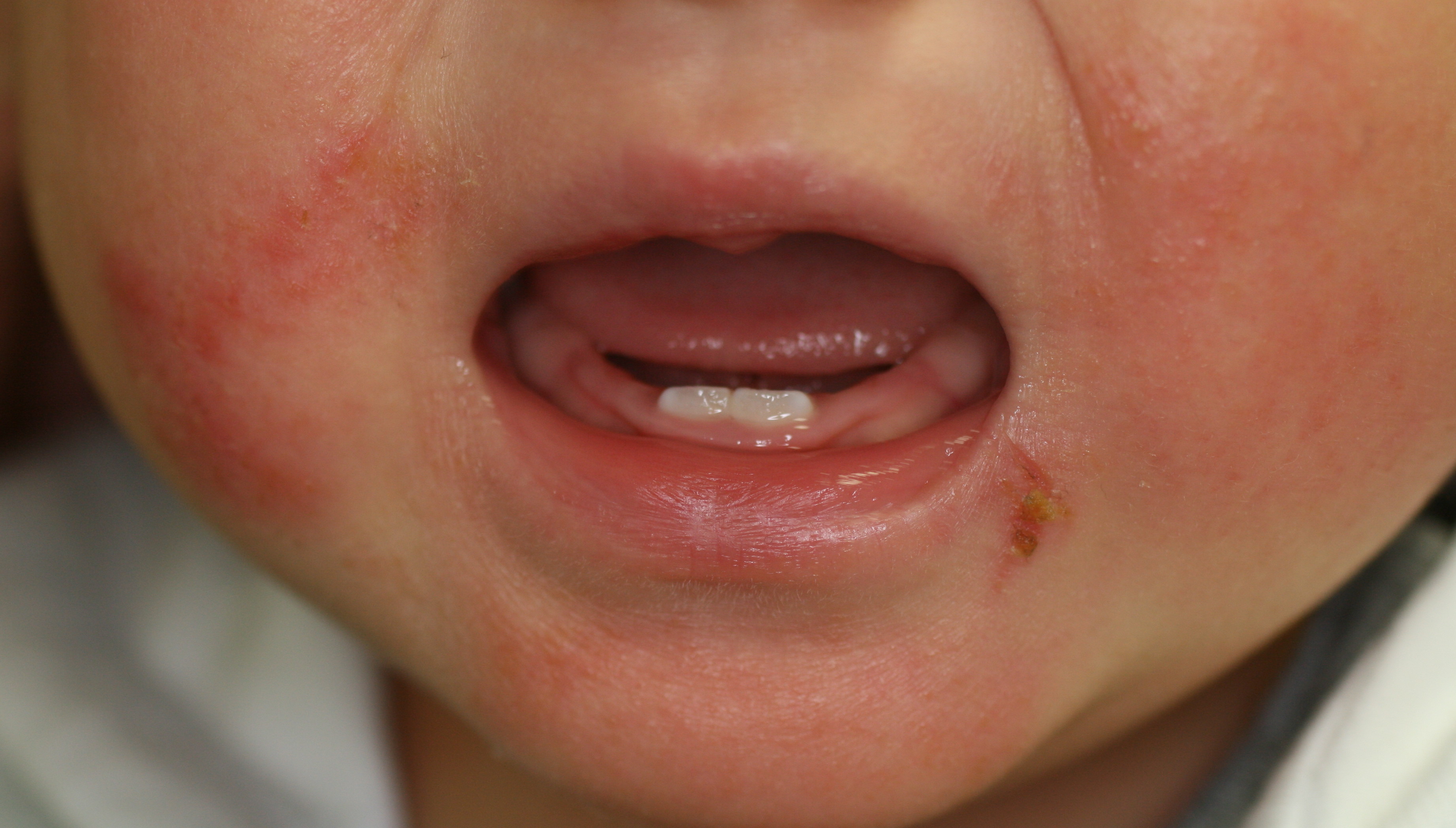赤ちゃん 口 の 周り 湿疹